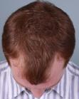 Before Hair Transplant &nbsp;Hairlines
